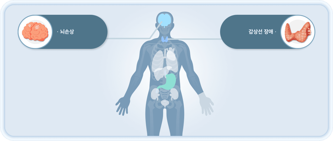 뇌손상, 갑상선 장애