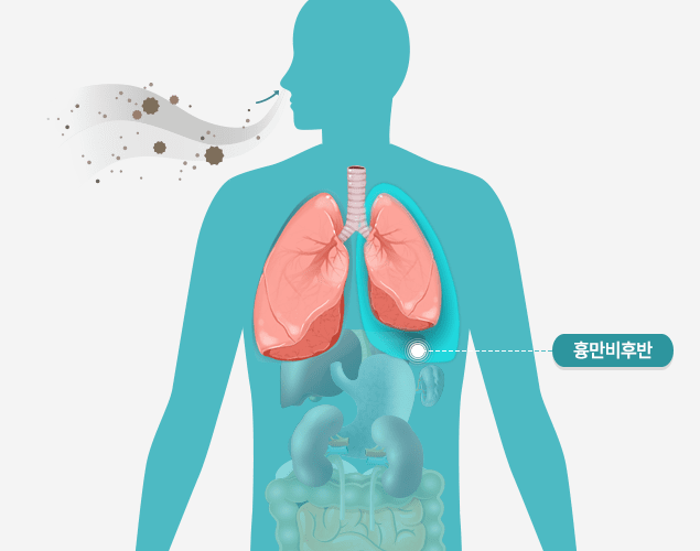 미만성 흉막비후