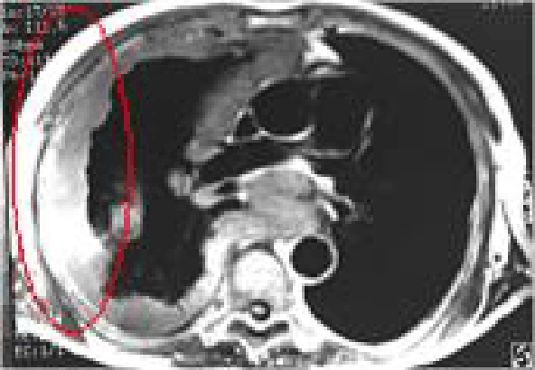 잠복기가 약 20~35년에 걸친 석면으로 인한 원발성 악성중피종에 대한 CT사진