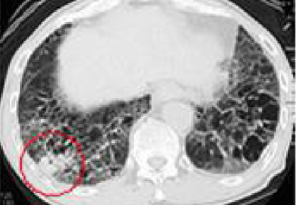 잠복기가 약 20~40년에 걸친 석면으로 인한 폐암에 대한 CT사진