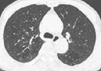 폐섬유화 소견에 따른 의심형 이미지