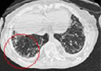 폐섬유화 소견에 따른 초기형 이미지