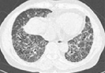 폐섬유화 소견에 따른 진행형 이미지