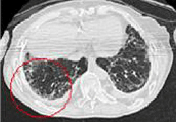 잠복기가 약 15~20년에 걸친 석면으로 인한 미만성 흉막비후에 대한 CT사진